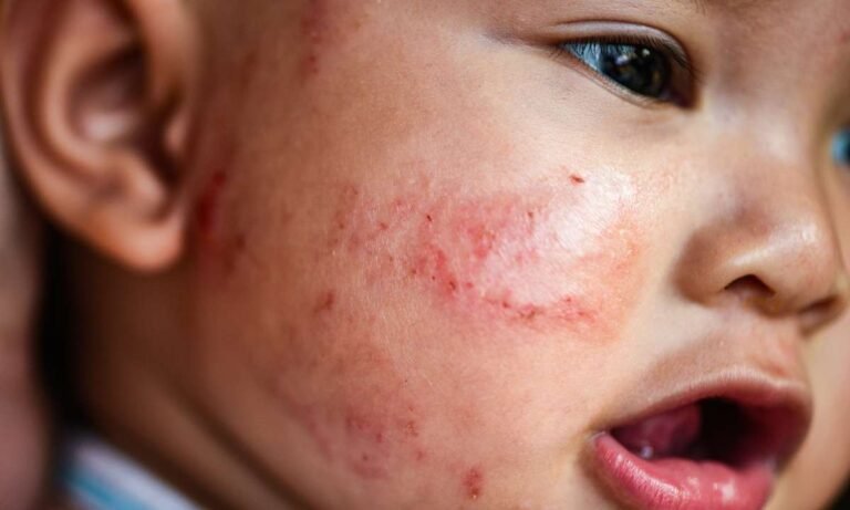 dream about eczema: What’s the Story?