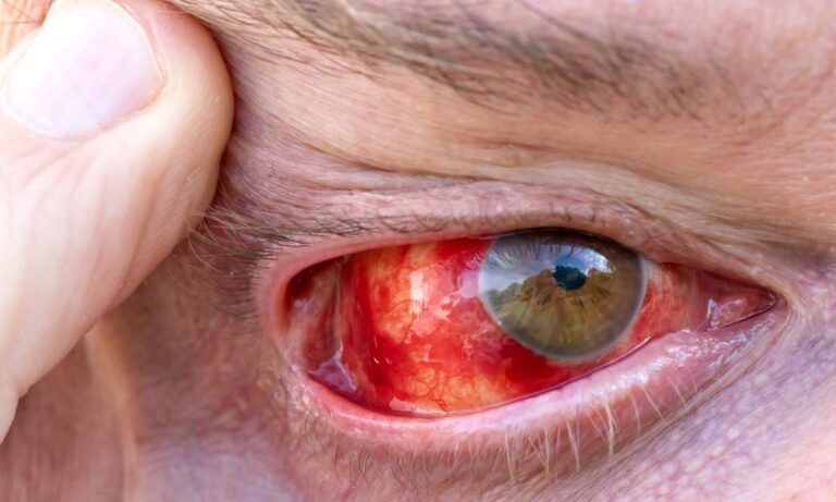 Dreams About Bleeding Eyes (17 Meanings & Interpretations)