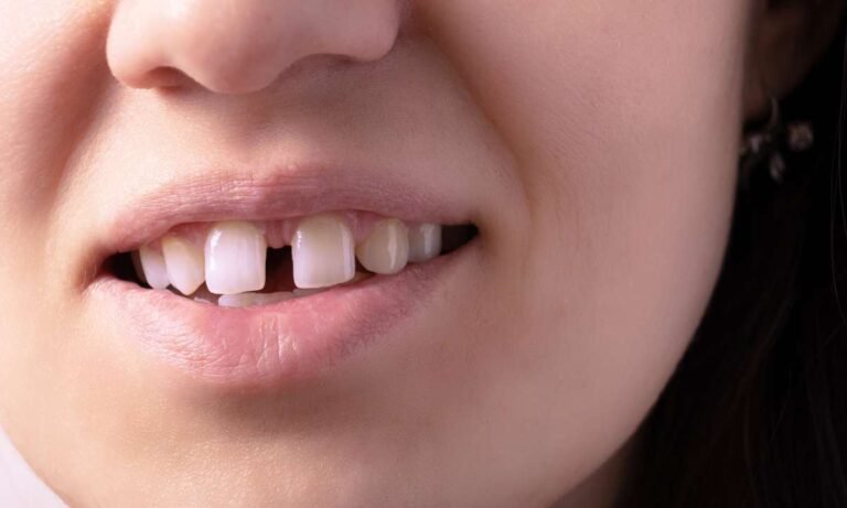 The Mystery Behind Dream About Gap In Front Teeth