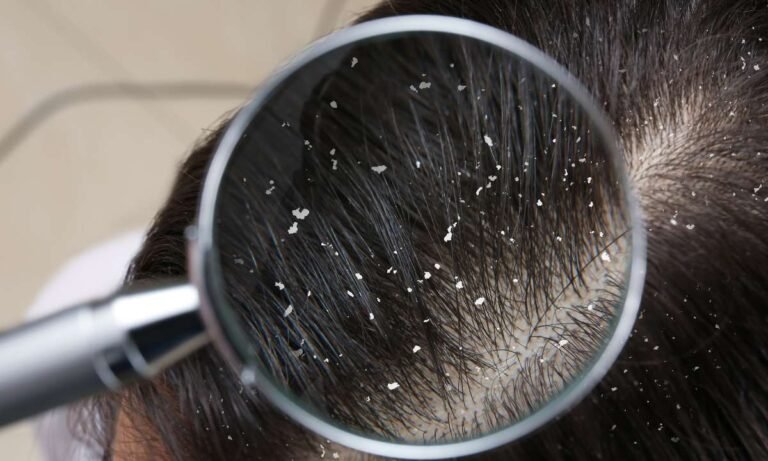 Flakes in Your Dreams: dream about dandruff