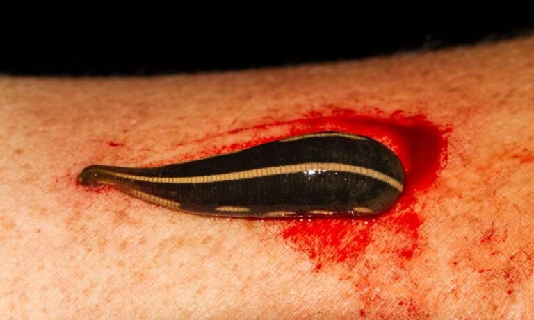 Dreams About Removing Leeches